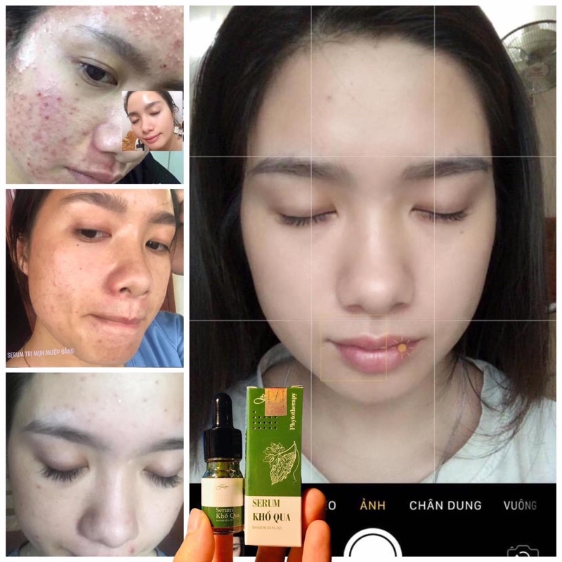 Serum khổ qua mướp đắng Lim giảm mụn mờ thâm nám hiệu quả