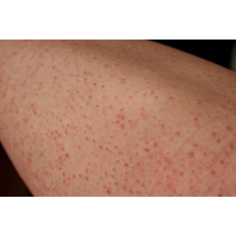 Thảo dược đánh bay Da sần sùi, thô ráp, Viêm lỗ chân lông, Lông quặp , Viêm nang lông