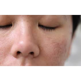 Thảo dược đánh bay Da sần sùi, thô ráp, Viêm lỗ chân lông, Lông quặp , Viêm nang lông