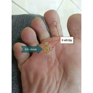 Chấm tẩy mụn cóc , mụn cơm , mắt cá , vết lan