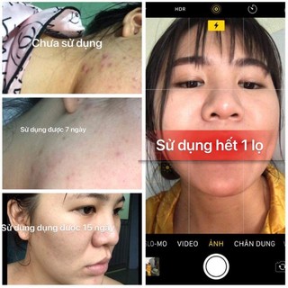 SERUM DIẾP CÁ IGREEN