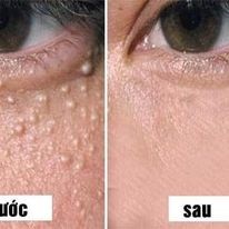 Kem xẹp mụn thịt mắt và vùng cổ , hỗ trợ làm sáng