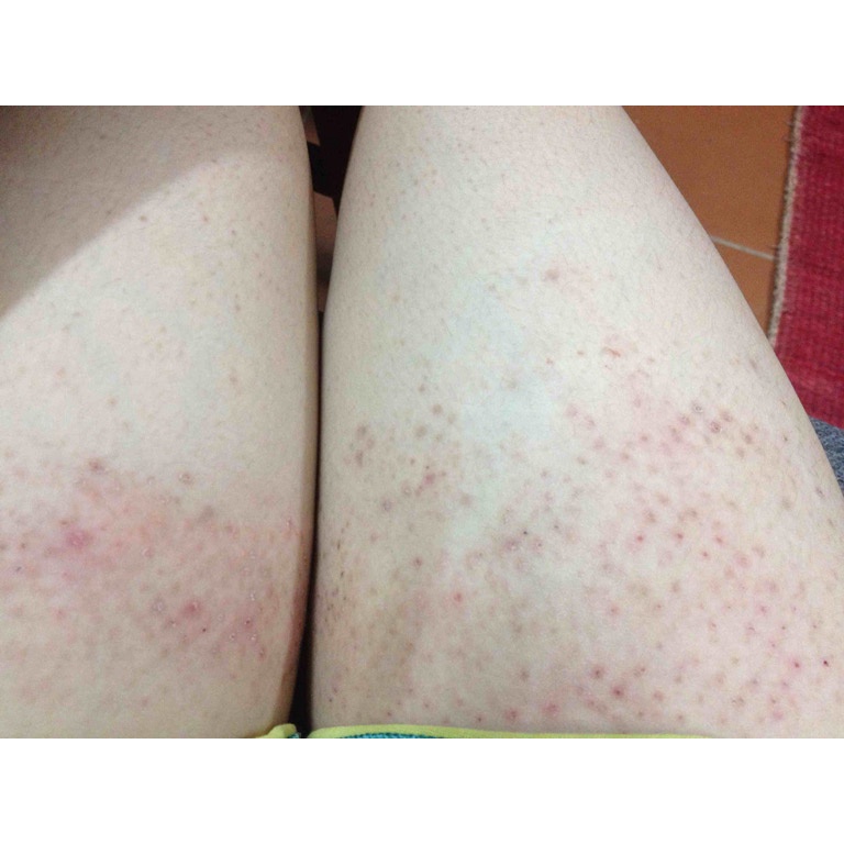 Thảo dược đánh bay Da sần sùi, thô ráp, Viêm lỗ chân lông, Lông quặp , Viêm nang lông