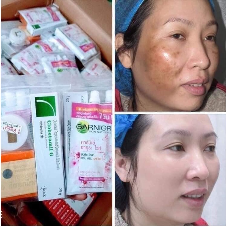 KEM NÁM THÁI LAN TÚI 5 MÓN ĐỦ TEM