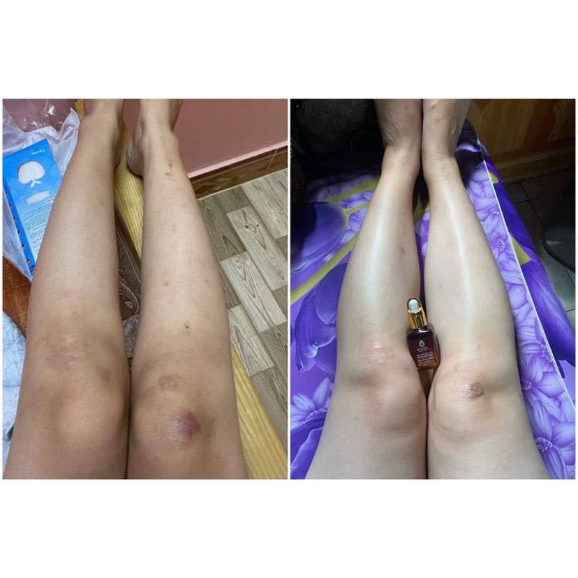 [THANH LÝ MÓP VỎ HỘP] TINH DẦU XÓA THÂM PHÚC MINH KHANG | BigBuy360 - bigbuy360.vn