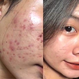 KEM DÀNH CHO DA MỤN MEDIBAC 𝐊𝐄𝐌 𝐌𝐔̣𝐍 𝐓𝐇𝐀̉𝐎 𝐃𝐔̛𝐎̛̣𝐂 𝐌𝐄𝐃𝐈𝐁𝐀𝐂