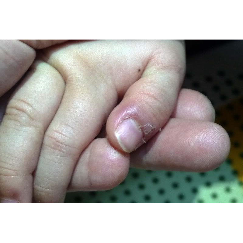 Thảo dược đánh bay XƯỚC MĂNG RÔ các đầu ngón tay, mé móng tay, lấy da thừa móng tay, chân_Sẵn Có