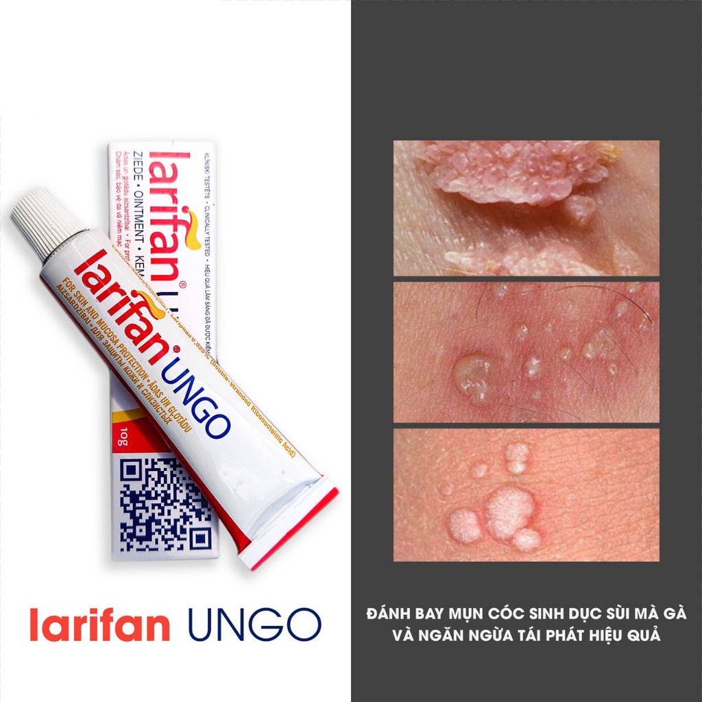 Ngăn ngừa tái phát sùi mào gà bằng kem bôi Larifan Ungo