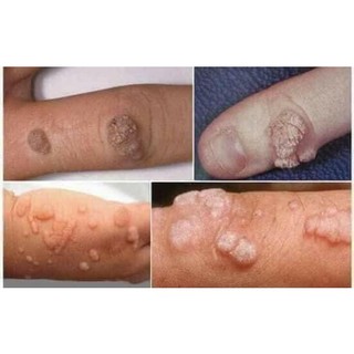 Chấm tẩy mụn cóc , mụn cơm , mắt cá , vết lan