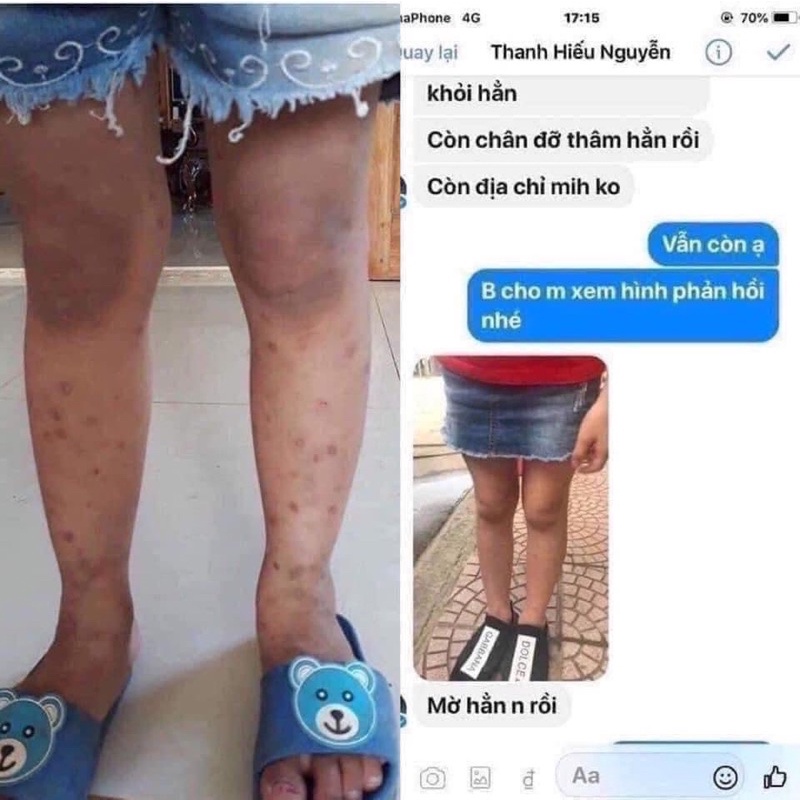 Kem bôi sẹo cho bé hiruscar kids thái lan