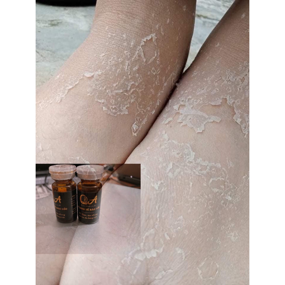 Vi kim thảo dược