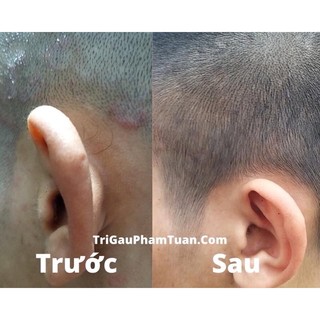 DẦU GỘI TRỊ NẤM DA ĐẦU ( CHÍNH HÃNG )