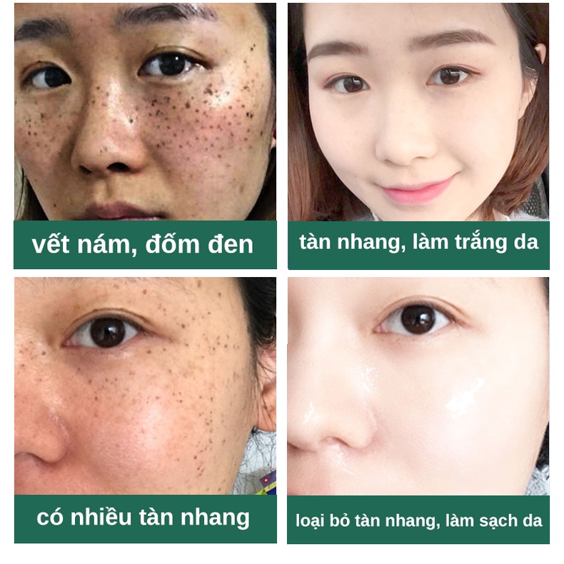 Kem nám tàn nhang kem trắng da Kem dưỡng da mặt 30g xóa vết thâm nám, tàn nhang làm mờ hắc tố, làm trắng da, săn chắc da tinh chất chất làm trắng da mặt chăm sóc