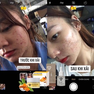 SERUM BHA TRI MỤN