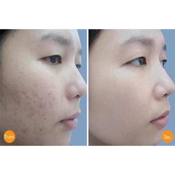 Kem Giảm Mụn Làm Sáng Thâm Mụn OPERA  Australia Anti- Acnes