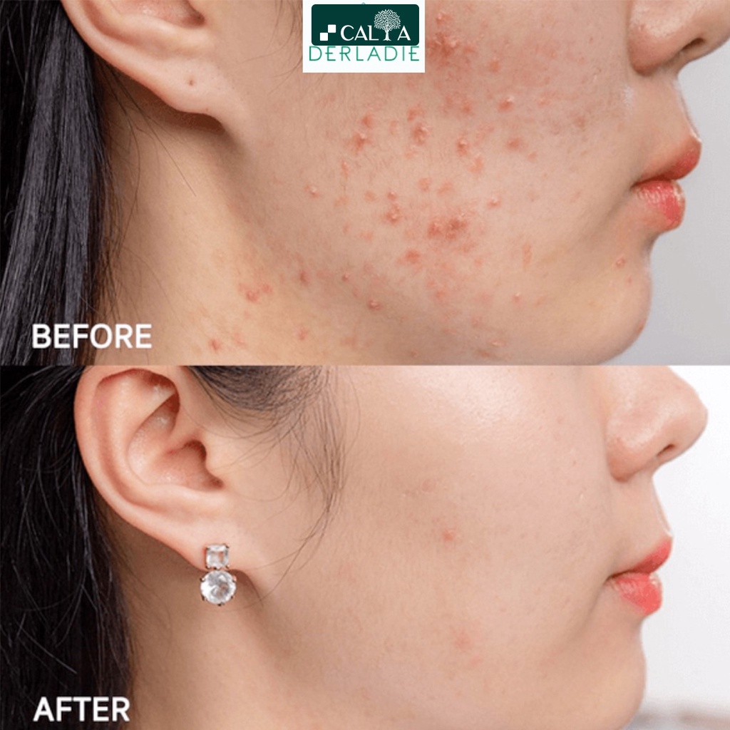 Tinh Chất Serum Derladie Chiết Xuất Tràm Trà Giảm Mụn, Sạch Nhờn - Derladie Herbal Ampoule For Blemish Serum 30ml