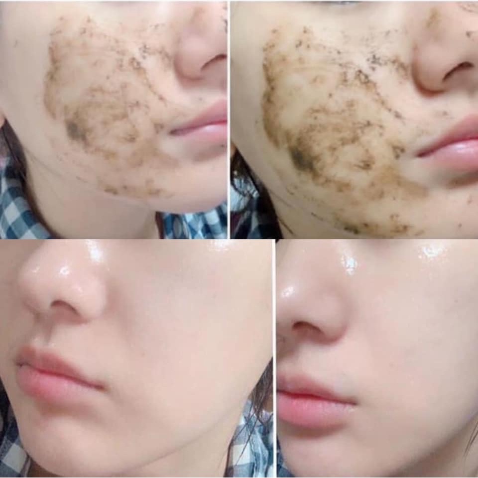 Vi kim tảo biển sạch mụn, sẹo lồi sẹo rỗ, nám, xoá nhăn, hết thâm, thu nhỏ lcl, dưỡng trắng da sd cho peel face va body