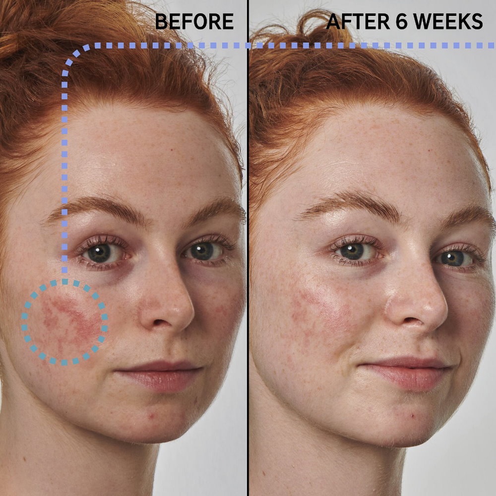 Serum giảm mụn giảm thâm đỏ The Inkey List Redness Relief 10% Azelaic Acid Super Solution [Bill Mỹ] Ref102