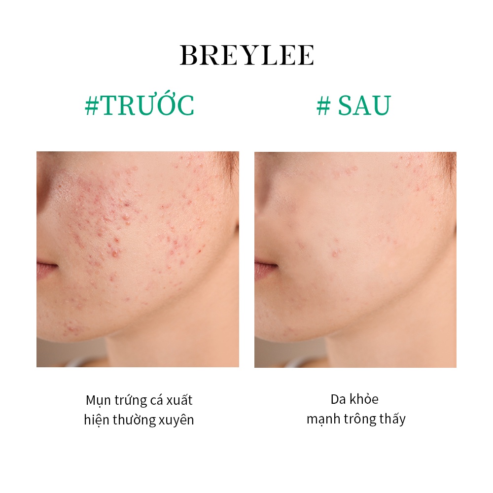 Serum Breylee 17ml / 30ml hỗ trợ giảm mụn trứng cá loại bỏ mụn trứng cá kiềm dầu