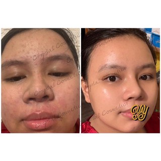 SERUM BHA TRI MỤN