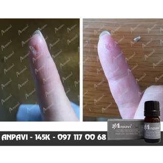 Chấm mụn cóc, mụn cơm, mắt cá chân ở mặt, bàn tay, bàn chân anpavi