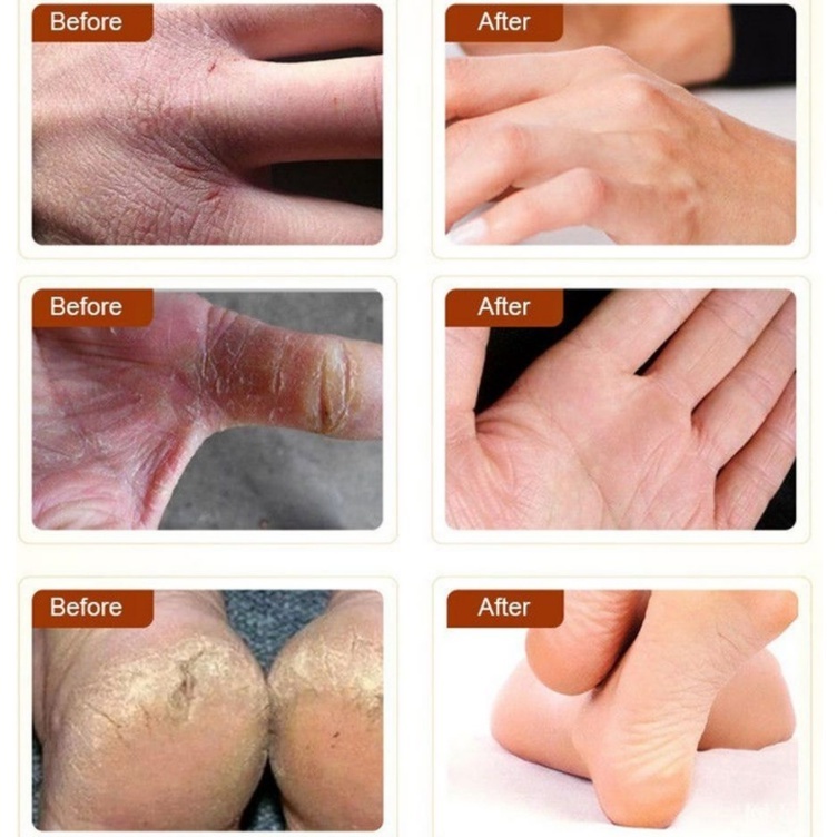 Kem dưỡng ẩm Oukeya Anti-Cracked Skin Repair Urea Cream