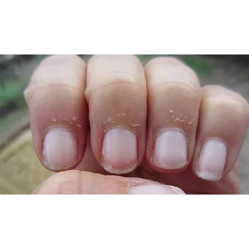 Thảo dược đánh bay XƯỚC MĂNG RÔ các đầu ngón tay, mé móng tay, lấy da thừa móng tay, chân_Sẵn Có