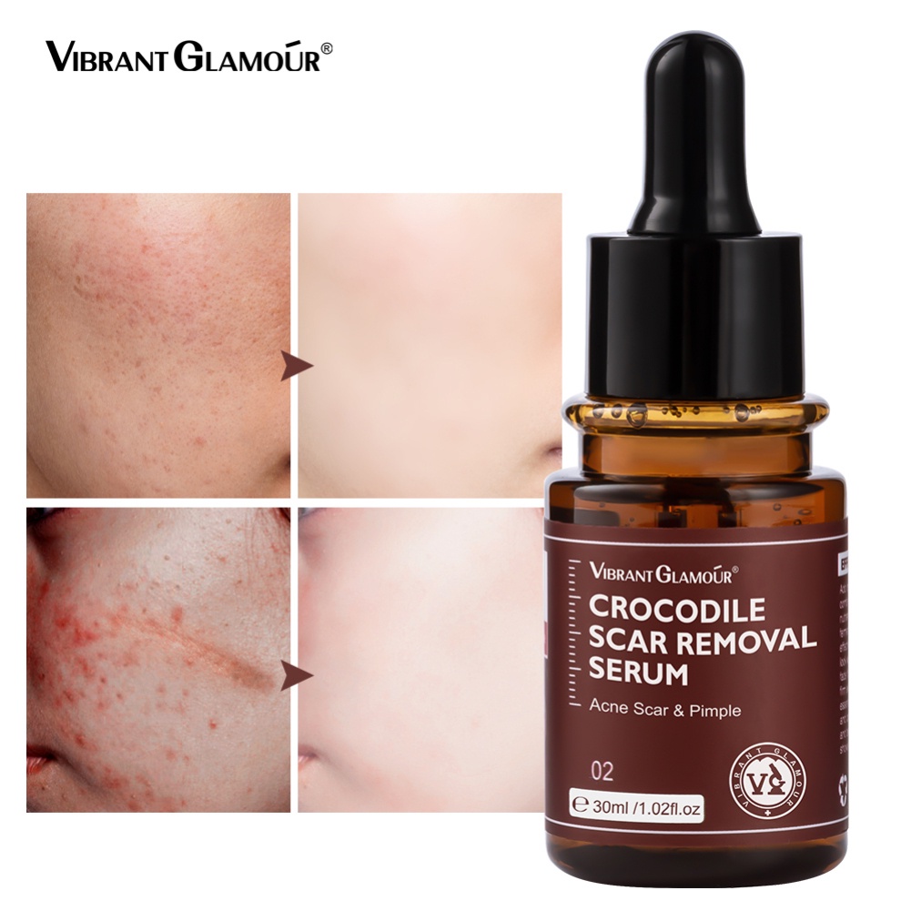 Vibrant Glamour Scar Repair Serum 30ml Điều trị mụn cá sấu thế hệ 2 Loại bỏ vết rạn da Loại bỏ sẹo mụn Dưỡng ẩm Chăm sóc da Beauty metro | BigBuy360 - bigbuy360.vn