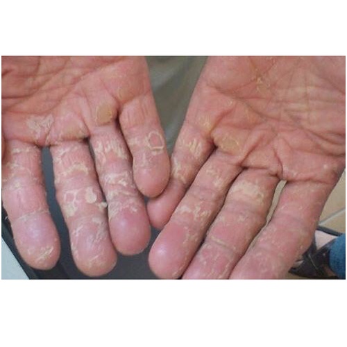 Thảo dược tốt đánh bay bong da đầu ngón tay ngón chân, lòng bàn tay, bàn chân