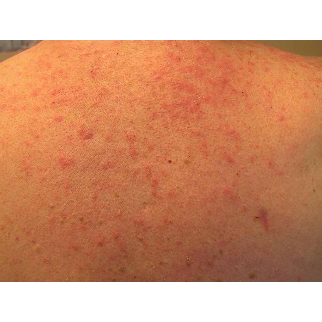 Thảo dược đánh bay Da sần sùi, thô ráp, Viêm lỗ chân lông, Lông quặp , Viêm nang lông