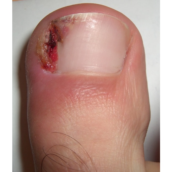 Thảo dược đánh bay V.i.ê.m KẼ_MÉ MÓNG NGÓN TAY, CHÂN do lấy da thừa móng tay, chân_Sẵn Có