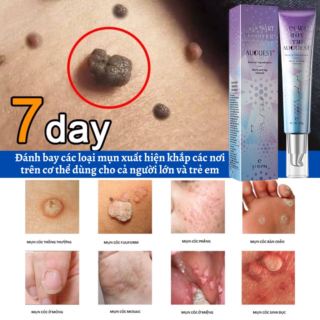 Gel tẩy nốt ruồi ,Tẩy nốt ruồi, cam kết tẩy nốt ruồi, mụn cóc, mụn thịt, sẹo lồi gây hại cho da
