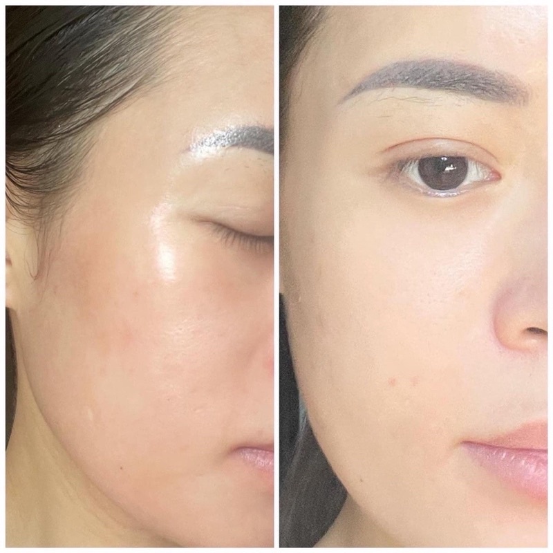 Tinh chất trẻ hoá loại nám Serum PRP Skinclinic