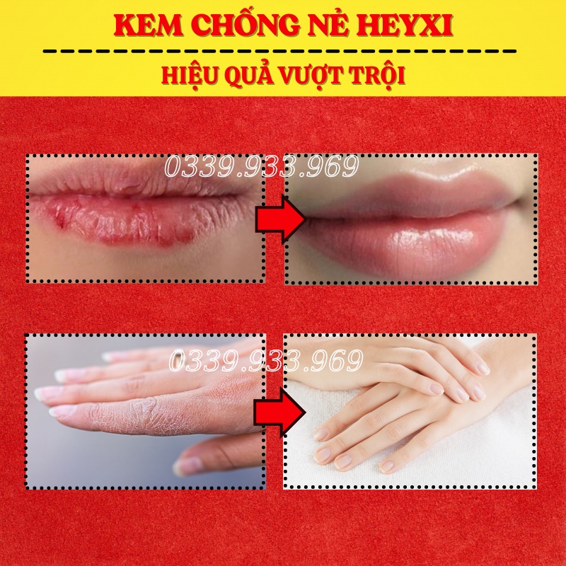 Kem Chống Nẻ - Kem Dưỡng Ẩm Chống Nứt Nẻ Da Heyxi 20g | BigBuy360 - bigbuy360.vn