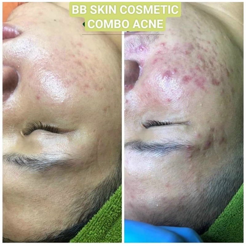 BB Serum Cream Acne Trắng Sáng Da , Mụn