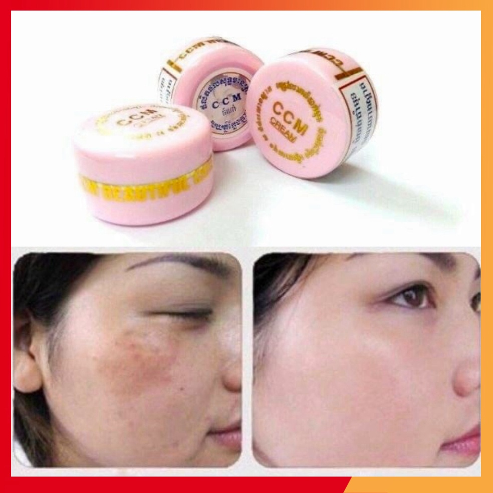 Kem Xóa Nám CCM Cream Thái Lan