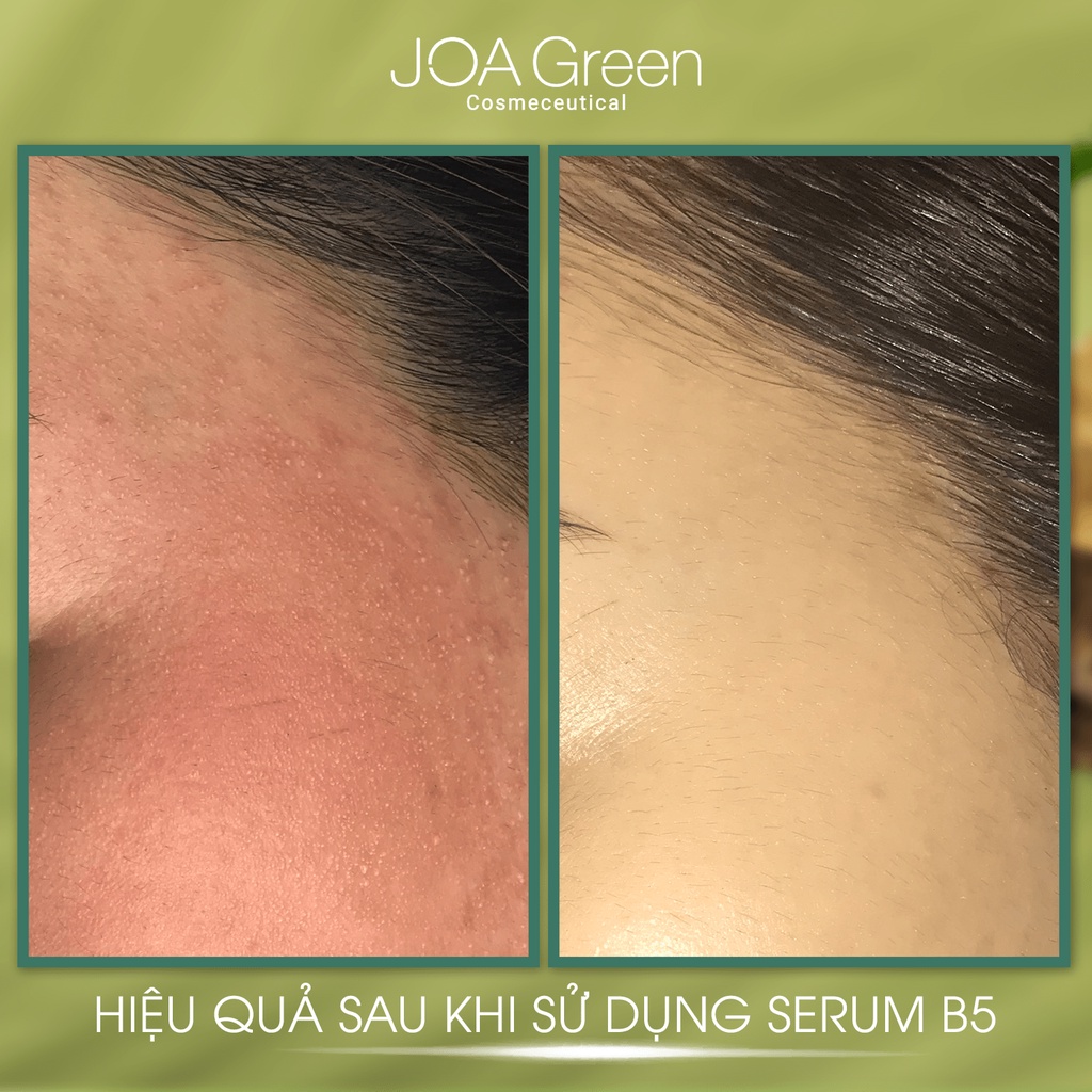 Serum phục hồi da Hyaluronic Acid + Vitamin B5 - JOA GREEN 30ml - Mỹ Phẩm MS COSMETIC