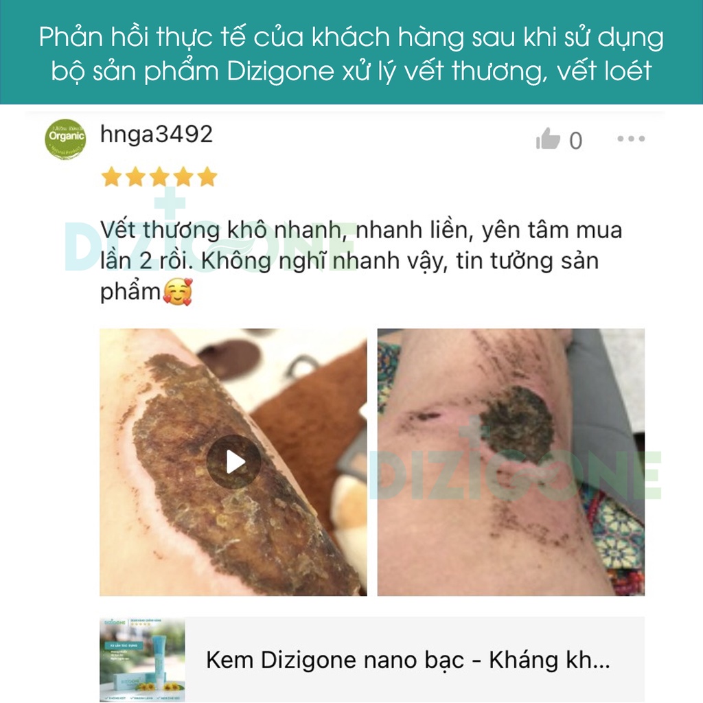 DIZIGONE 300ml kháng khuẩn & DIZIGONE nano bạc: Kháng khuẩn da, lành vết thương, ngăn ngừa sẹo