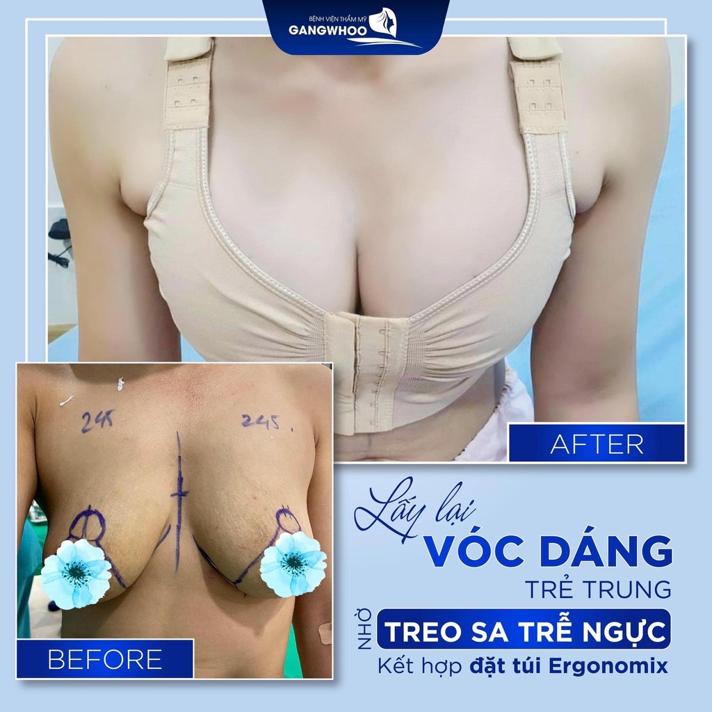 Áo Định Hình Sau Nâng Ngực Stuttgarter Gurtel