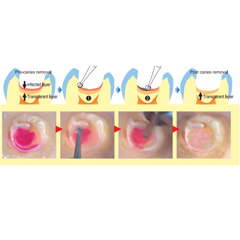 Mũi khoan nạo ngà nha khoa - Mũi gắn tay khoan chậm lấy mô ngà bệnh lý trám răng sâu - Dụng cụ và thiết bị nha khoa