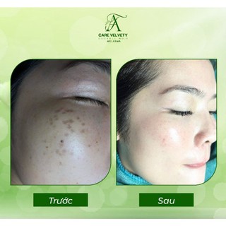 KEM HOA ANH ĐÀO MELASMA CREAM