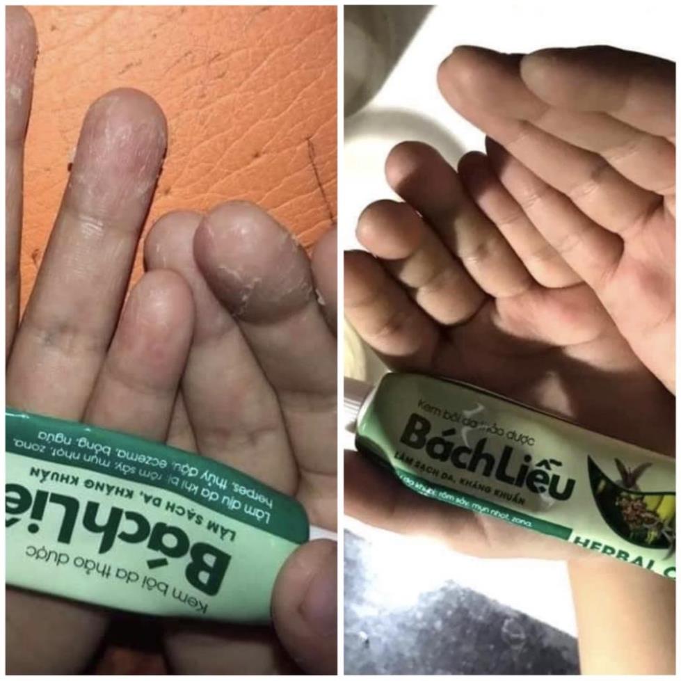 Kem Bôi Da Thảo Dược Bách Liễu - Bôi Ngay Khi Bị: Mẩn Ngứa, Viêm Da, Nấm Da, Dị Ứng