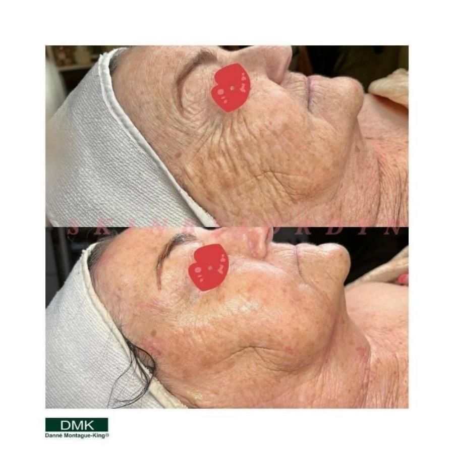 Bộ Enzyme therapy tái tạo da DMK