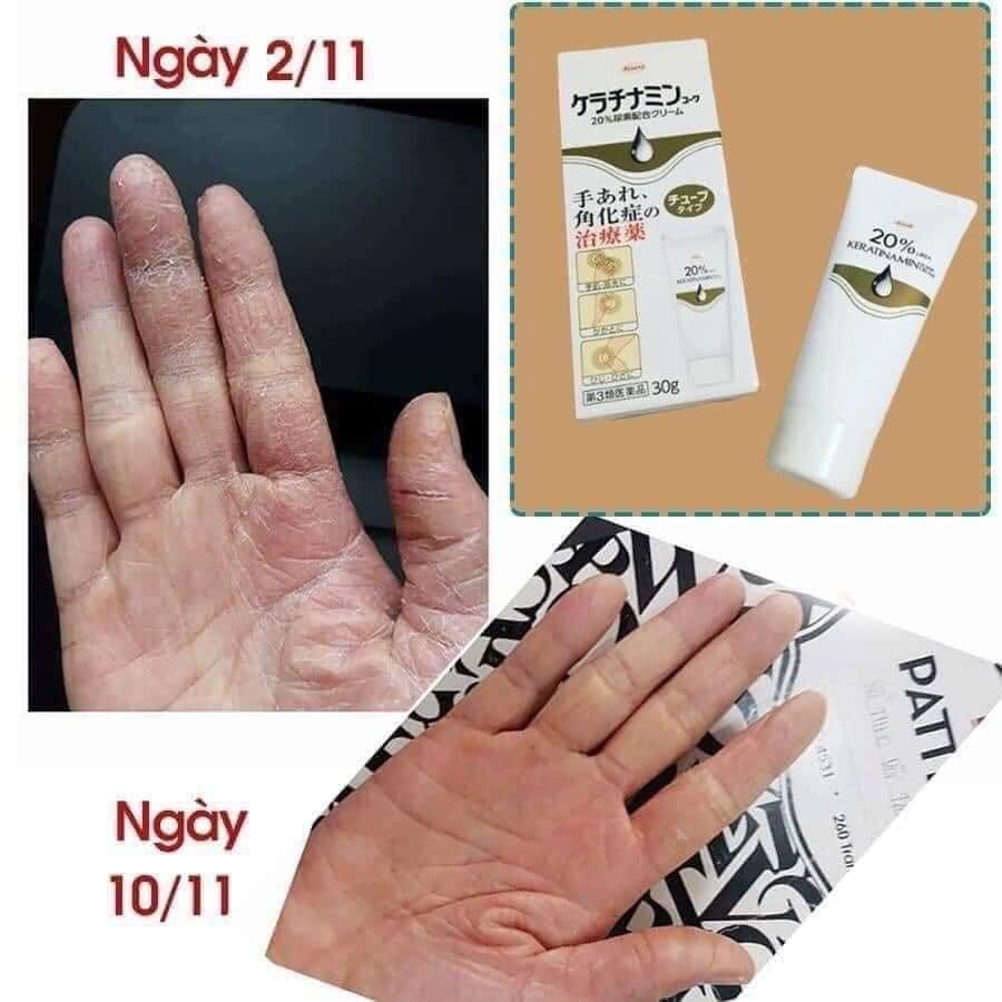 Kem á sừng Kowa Cream giảm nứt nẻ, khô ráp Nhật Bản 30gram