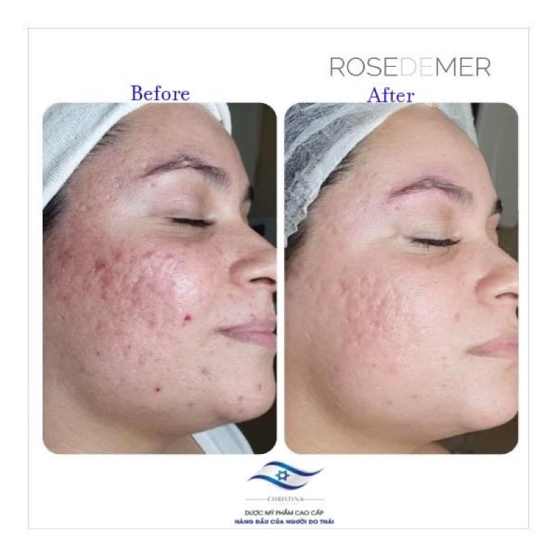 Combo Peel Thảo Dược Ch.ris.tina Rose.demer 2A +2B Sea Her.bal