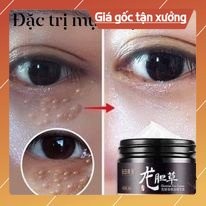 Kem mụn thịt quanh mắt (trungcuong1688)