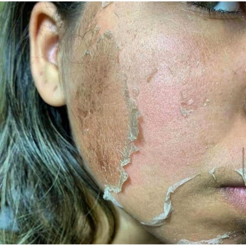 Combo Peel Thảo Dược Ch.ris.tina Rose.demer 2A +2B Sea Her.bal