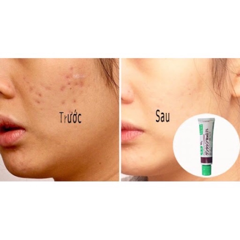 Gel Giảm Thâm, Mờ Sẹo Nhật 10g