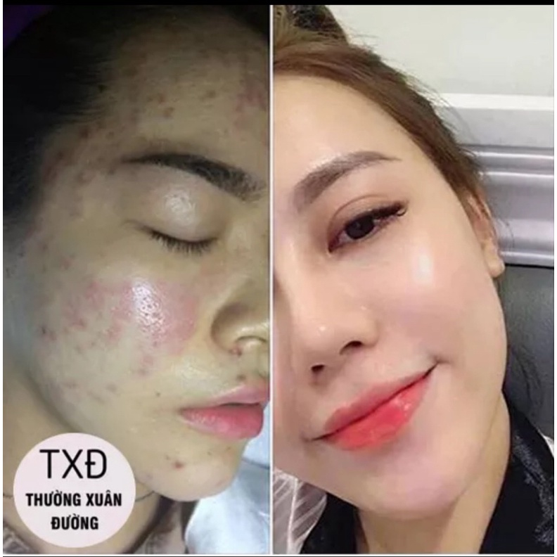 Kem Mụn Hoa Đào Thường Xuân Đường