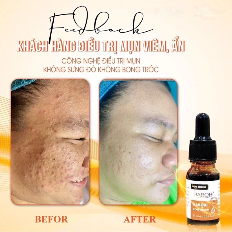 Serum giảm mụn, kiềm dầu, se khít lỗ chân lông, sáng da mờ thâm 6day Habobi